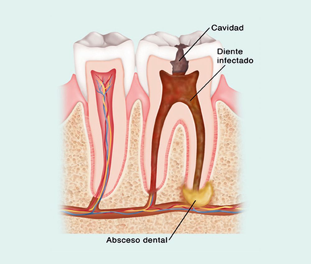 Absceso Dental