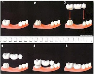 Tác dụng của cầu răng