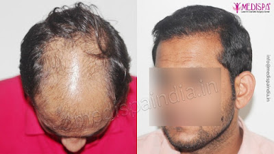 hair transplant in Jaipur