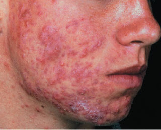 Obat Gatal Dermatitis atau scabies di selangkangan 