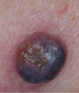 Nodular Melanoma