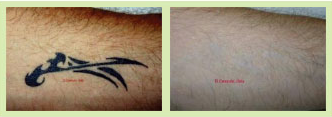 Erase Tattoo Removal: Myths on Laser Tattoo Removal Continued…