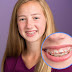 Những lưu ý đề phòng cho trẻ khi đang niềng răng ?