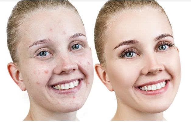  Get Rid of Pimples and Acne Overnight Naturally