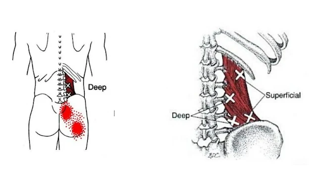 lumbalgia y ciática - cuadrado lumbar deep - mc spa