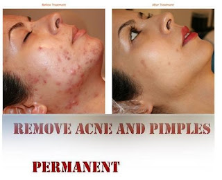 10 Tips To Remove Acne And Pimples Permanently