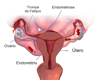 posso engravidar com endometriose