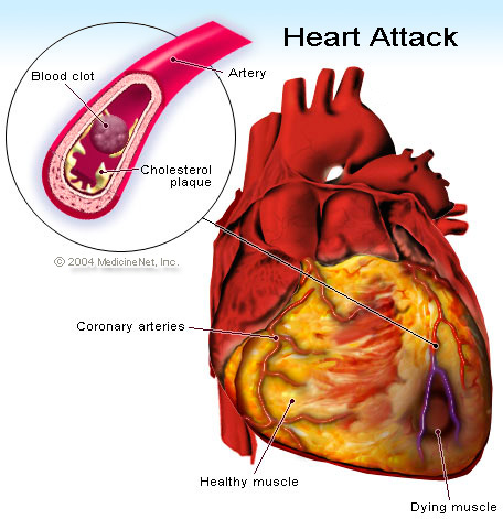 Heart attack, heart attack and symptoms, diseases of heart and symptoms