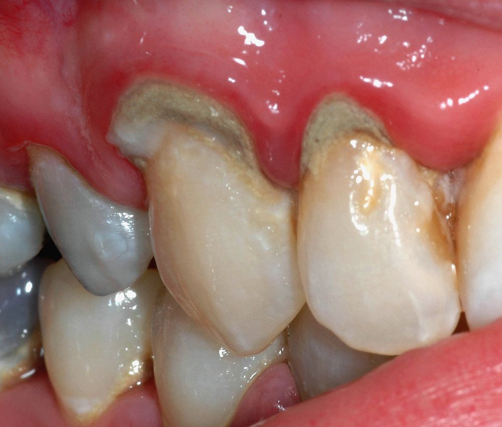 Gum Infections