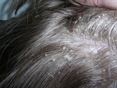 7 Easy Ways to Overcome Dandruff In One Night