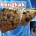 Obat hati liver perut membesar bengkak herbal thumbnail