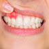 Nướu răng bị sưng đau - Cách điều trị an toàn nhất