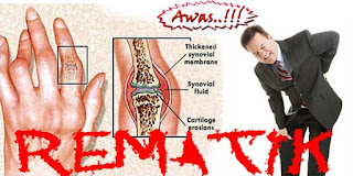 Obat rematik buatan sendiri