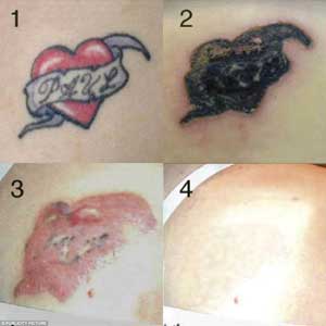 Tca Tattoo Removal