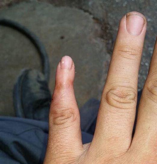 Seorang Gadis Kecil secara tidak sengaja memotong Kuku jari Tangan Anda Hingga Jarinya Cedera