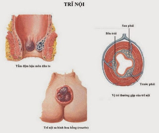 Phẫu thuật cắt trĩ ở đâu tốt nhất tại Bình Dương