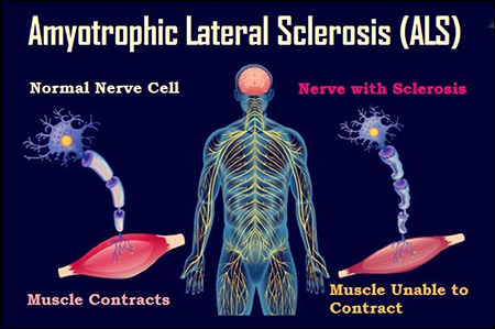 Amyotrophic Lateral Sclerosis