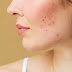 चेहरे के दाग धब्बे मुँहासे का घरेलू उपचार : Home Remedies for Acne in Hindi