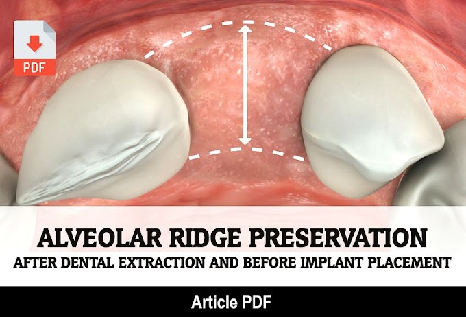 PDF: Alveolar Ridge Preservation after dental extraction and before implant placement: a literature review