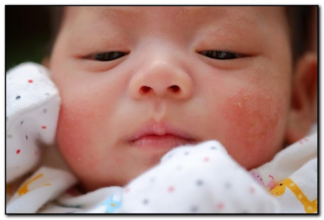 what causes baby acne on face