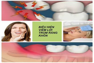 Dấu hiệu nhận biết răng khôn mọc đâm vào lợi-1