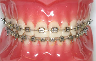 Quy trình niềng răng móm an toàn-1