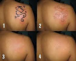 http://www.solusidewasa.com/2014/03/remover-obat-pengilang-tatto-permanet.html 