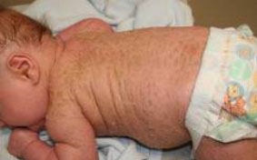 Lamellar Ichthyosis