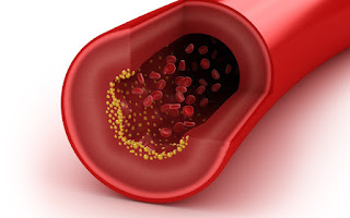 Las arterias son obstruidas a causa del colesterol malo