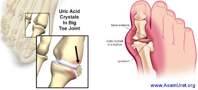 obat asam urat tradisional