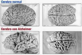 Alzheimer