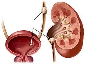 Do kidney stones hurt?