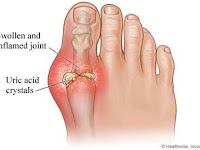 Mengobati Asam Urat Dengan Bahan Alami