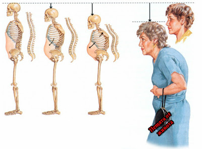 Остеопороза - лекуване с народни методи