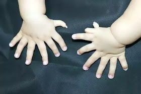 Baby Born With 31 Fingers & Toes Undergoing Surgery