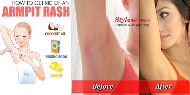 How To Get Rid Of An Armpit Rash - Rash Of Underarms