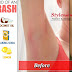 How To Get Rid Of An Armpit Rash - Rash Of Underarms