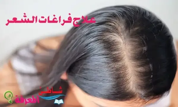 علاج فراغات الشعر في مقدمة الرأس بالأعشاب