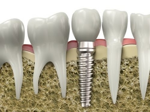 Videoaula: "Implantes Imediatos Pós-Extração"