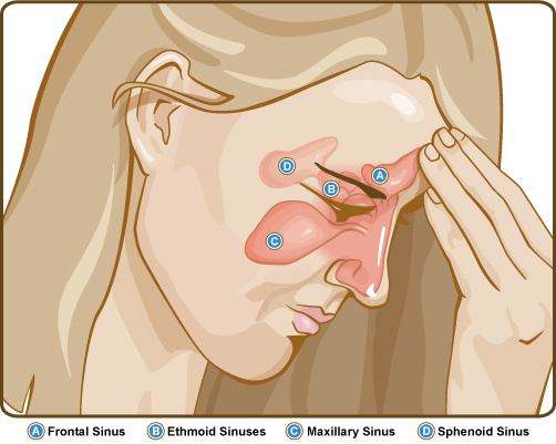 sinus strain one facet