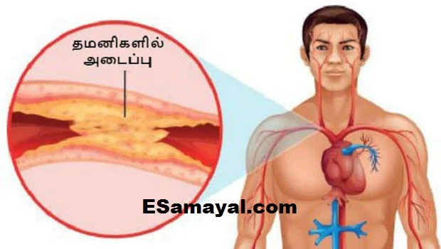 இரத்த குழாயில் அடைப்பு உள்ளதை வெளிக்காட்டும் அறிகுறிகள்