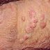 Obat Kutil Kelamin Pria Alami thumbnail