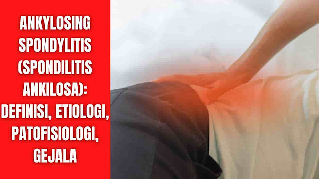 Ankylosing Spondylitis (Spondilitis Ankilosa): Definisi, Etiologi, Patofisiologi, Gejala Definisi Ankylosing spondylitis adalah penyakit peradangan yang, seiring waktu, dapat menyebabkan beberapa tulang di tulang belakang (vertebra) menyatu. Sekering ini membuat tulang belakang kurang fleksibel dan dapat mengakibatkan postur membungkuk. Jika tulang rusuk terpengaruh, akan sulit untuk bernapas dalam-dalam.  Ankylosing spondylitis (AS) merupakan sebuah penyakit inflamasi kronis pada tulang belakang aksial yang dapat bermanifestasi dengan berbagai tanda dan gejala klinis. Nyeri punggung kronis dan kekakuan tulang belakang progresif adalah ciri paling umum dari penyakit ini. Keterlibatan tulang belakang dan sendi sakroiliaka (SI), sendi perifer, jari, entheses adalah karakteristik dari penyakit ini. Gangguan mobilitas tulang belakang, kelainan postural, nyeri bokong, nyeri pinggul, artritis perifer, enthesitis, dan dactylitis ("sausage digits") semuanya berhubungan dengan AS.  Organ ekstraskeletal juga dapat terkena penyakit ini. Manifestasi ekstraartikular yang paling umum dari AS termasuk penyakit radang usus (hingga 50%), uveitis anterior akut (25% hingga 35%), dan psoriasis (sekitar 10%). AS juga dikaitkan dengan peningkatan risiko penyakit kardiovaskular. Penyebab peningkatan risiko ini telah dipostulasikan karena peradangan sistemik yang terbukti pada AS. Komplikasi paru juga berhubungan dengan AS, seperti berkurangnya ekspansi dinding dada dan penurunan mobilitas tulang belakang mempengaruhi pasien untuk pola paru restriktif.  Akhirnya, AS mempengaruhi orang untuk setidaknya dua kali lipat peningkatan insiden fraktur kerapuhan vertebra. Pasien-pasien ini juga pada peningkatan risiko subluksasi atlantoaksial, cedera tulang belakang, dan, jarang, sindrom cauda equina.    Etiologi Penyebab ankylosing spondylitis (AS) sebagian besar masih idiopatik, tetapi tampaknya ada korelasi antara prevalensi AS pada populasi tertentu dan prevalensi human leukocyte antigen (HLA)-B27 pada populasi yang sama. Di antara orang-orang yang HLA-B27 positif, prevalensi AS adalah sekitar 5% sampai 6%. Di Amerika Serikat, prevalensi HLA-B27 bervariasi antar kelompok etnis. Menurut survei 2009, tingkat prevalensi HLA-B27 adalah 7,5% di antara orang kulit putih non-Hispanik, 4,6% di antara orang Meksiko-Amerika, dan 1,1% di antara orang kulit hitam non-Hispanik.    Patofisiologi Ankylosing spondylitis (AS) adalah penyakit inflamasi kronis dengan onset yang berbahaya. Tanda dan gejala muskuloskeletal progresif, dan seringkali ekstraskeletal, merupakan ciri khas penyakit ini. Tingkat perkembangan dapat bervariasi dari satu pasien ke pasien berikutnya. Patologi utama spondyloarthropathies adalah entesitis dengan peradangan kronis, termasuk limfosit T CD4 dan CD8 dan makrofag. Sitokin, khususnya tumor necrosis factor-α (TNF-α) dan transforming growth factor-β (TGF-β), juga penting dalam proses inflamasi dengan menyebabkan inflamasi, fibrosis, dan osifikasi di tempat entesitis.    Gejala Tanda dan gejala awal ankylosing spondylitis mungkin termasuk nyeri dan kekakuan di punggung bawah dan pinggul, terutama di pagi hari dan setelah periode tidak aktif. Sakit leher dan kelelahan juga sering terjadi. Seiring waktu, gejala mungkin memburuk, membaik atau berhenti pada interval yang tidak teratur.  Daerah yang paling sering terkena adalah: Sendi antara pangkal tulang belakang dan panggul Tulang belakang di punggung bawah Tempat di mana tendon dan ligamen menempel pada tulang, terutama di tulang belakang, tetapi kadang-kadang di sepanjang bagian belakang tumit Tulang rawan antara tulang dada dan tulang rusuk Sendi pinggul dan bahu    Faktor Risiko Pria lebih mungkin mengembangkan ankylosing spondylitis daripada wanita. Onset umumnya terjadi pada akhir masa remaja atau awal masa dewasa. Kebanyakan orang yang menderita ankylosing spondylitis memiliki gen HLA-B27. Tetapi banyak orang yang memiliki gen ini tidak pernah mengalami ankylosing spondylitis.