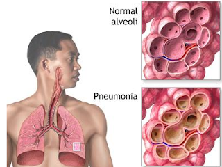 Pneumonia infected Lungs