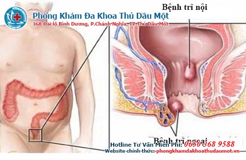 Hình ảnh của bệnh trĩ ngoại