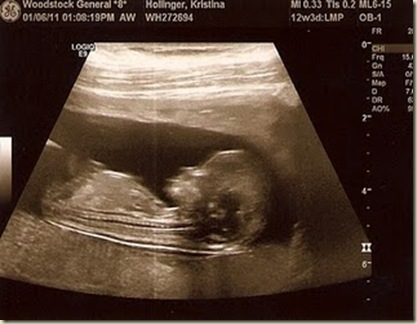 Ultrasound13weeksimage1