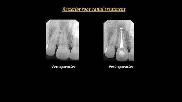 Root Canal Treatment Hyderabad