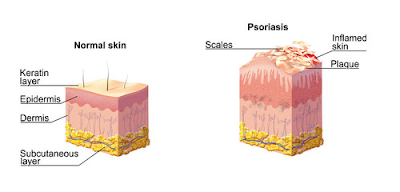 Ayurvedic treatment for psoriasis on face in nagpur