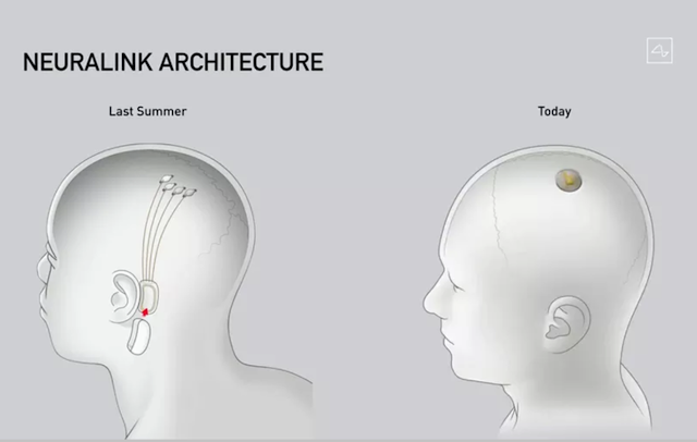 "The difference between last year's Neuralink BMI chip, which was implanted near the ear (left), and the latest device aligned with the skull (right). (Neuralink via The Verge)"