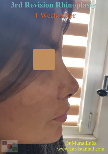 1 week after - 3rd Revision Rhinoplasty - Nostril Stenosis and Pollybeak Deformity - Complication Nose Surgery